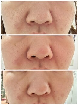 はあと/毛穴ケア