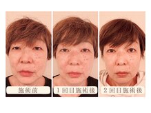 モアビューティー 紙屋町店/【年齢関係ございません！】