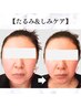 【シミを根本から解決】最新の光フェイシャルでシミのない素肌美人に