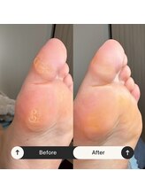 マオヌー(MAONU)/式足裏角質ケア　症例写真