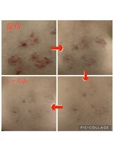 かず整骨院/光療法で赤みを抑える！