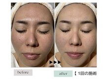 ジェニックサロン グランギンザ 水戸(GENIC SALON GRAND GINZA)/高濃度水素毛穴洗浄/毛穴/くすみ
