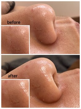 毛穴専科/韓国肌管理◇ 学割u24あり