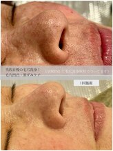 なごみ/当店自慢の毛穴洗浄