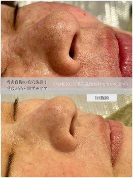 なごみ/当店自慢の毛穴洗浄