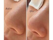 ルブラン(Lu'Bulan)/【毛穴エクストラクション】