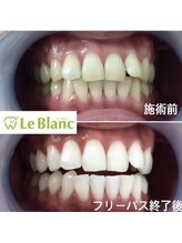 ルブラン 奈良店(Le Blanc)/照射中もリラックス♪