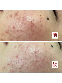 ハズキ(HAZUKI)/ハーブピーリングで【脱】肌悩み