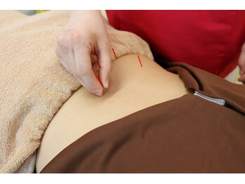 琴似の鍼灸整骨院/【施術風景】　鍼施術