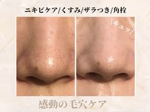 シャングリラ(Shangri-La)/ハイドラ毛穴洗浄