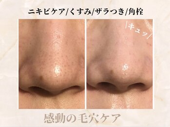 シャングリラ(Shangri-La)/ハイドラ毛穴洗浄