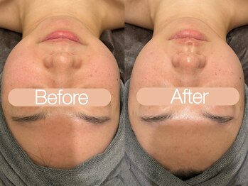 クレヴィア バイ サイバーエステ(CREBIA)/浮腫も改善【高濃度炭酸パック】