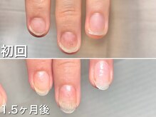 グラシュータン(gracieux temps)/【深爪矯正13000円】