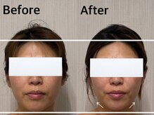 ベール(BEHL)/コルギのBefore After