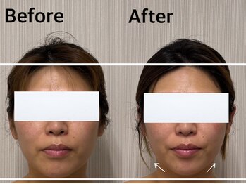 ベール(BEHL)/コルギのBefore After