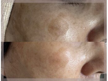 サロンクレア(SALON Claire)/十数年前の諦めていたシミも◎