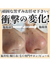 ピュール 鯖江店(PUR)/毛穴/毛穴ケア/毛穴洗浄