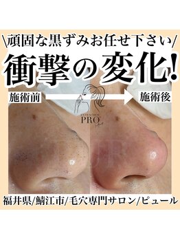 ピュール 鯖江店(PUR)/毛穴/毛穴ケア/毛穴洗浄