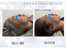 ユアーズ ビューティー(YOURS beauty)/小顔施術1回　ビフォーアフター