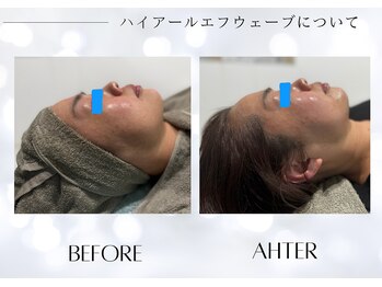 ユアーズ ビューティー(YOURS beauty)/小顔施術1回　ビフォーアフター
