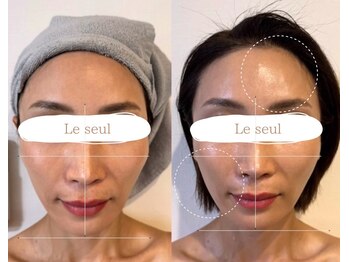 ルソール(Le seul)の写真/【空圧で肌の奥に届ける/痛みダウンタイムなし】医療提携サロンだから入手可能なヒト幹細胞原液導入