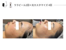 スパレーカ(Spa laka)/光カスタマイズ＋ララピール