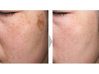 ドゥマイン(Do Mynd)/シミケア