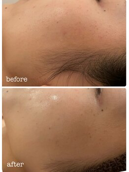ミラ(Mila)/お顔脱毛&毛穴洗浄 BeforeAfter