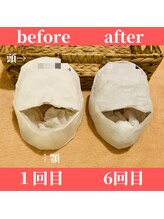ロータス ビューティー(LOTUS Beauty)/石膏パックビフォーアフター