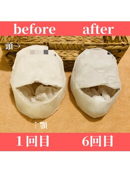 ロータス ビューティー(LOTUS Beauty)/石膏パックビフォーアフター