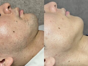 エモーショナル 姫路(Emotional)/ひげ剃り卒業!