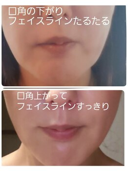 シェアキ(Chez Aki)/光フェイシャル Before/After