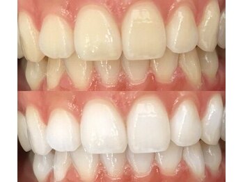 シエル(Ciel)/★誰もが感動★ホワイトニング