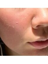 ハーゼ(Hase)/２４時間ハーブピーリング◎毛穴