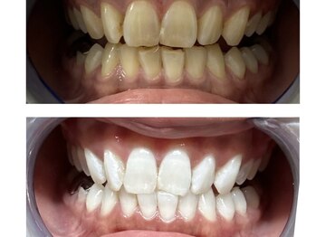 シード(SHE°)/セルフホワイトニング