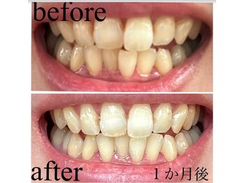 エクシアホワイトニング 武蔵小杉店/ビフォーアフター