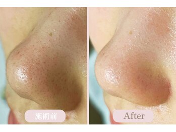 エピル(EPIL)/DEEPクリアスキン毛穴洗浄症例