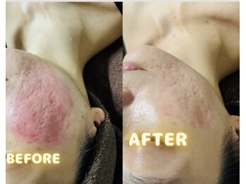 サロンララ(Salon Lala)/ニキビ特化,ハーブピーリング