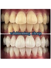 ホワイトニングショップ 鳳店/BeforeAfter 美白ホワイトニング