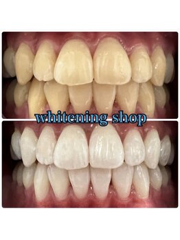 ホワイトニングショップ 鳳店/BeforeAfter 美白ホワイトニング