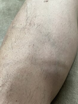 アイフィル(Eye FILL)/自分の左足脱毛効果