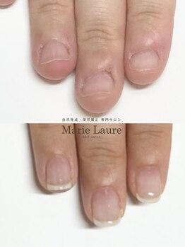 マリーロール 梅田店(Marie Laure)/自爪育成/深爪矯正/ネイルケア