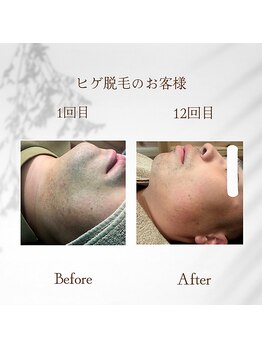 クリスタル(Crystal)/men'sも全身脱毛★好印象&好感度