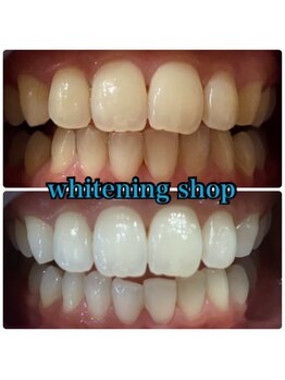 ホワイトニングショップ 郡山店/学生の方も歯が命★