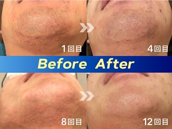 アリッサムフォーメン 岡山店(ALiSSUM for men)/1回目→4回目→8回目→12回目