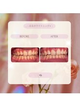 プラスビー 2号店(+b)/ホワイトニングビフォーアフター