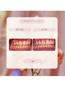 プラスビー 2号店(+b)/ホワイトニングビフォーアフター
