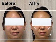 ベール(BEHL)/コルギのBefore After