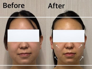 ベール(BEHL)/コルギのBefore After