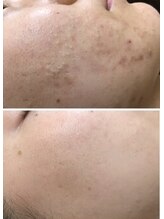 アンジェロ/【ニキビケア】肌育プログラム